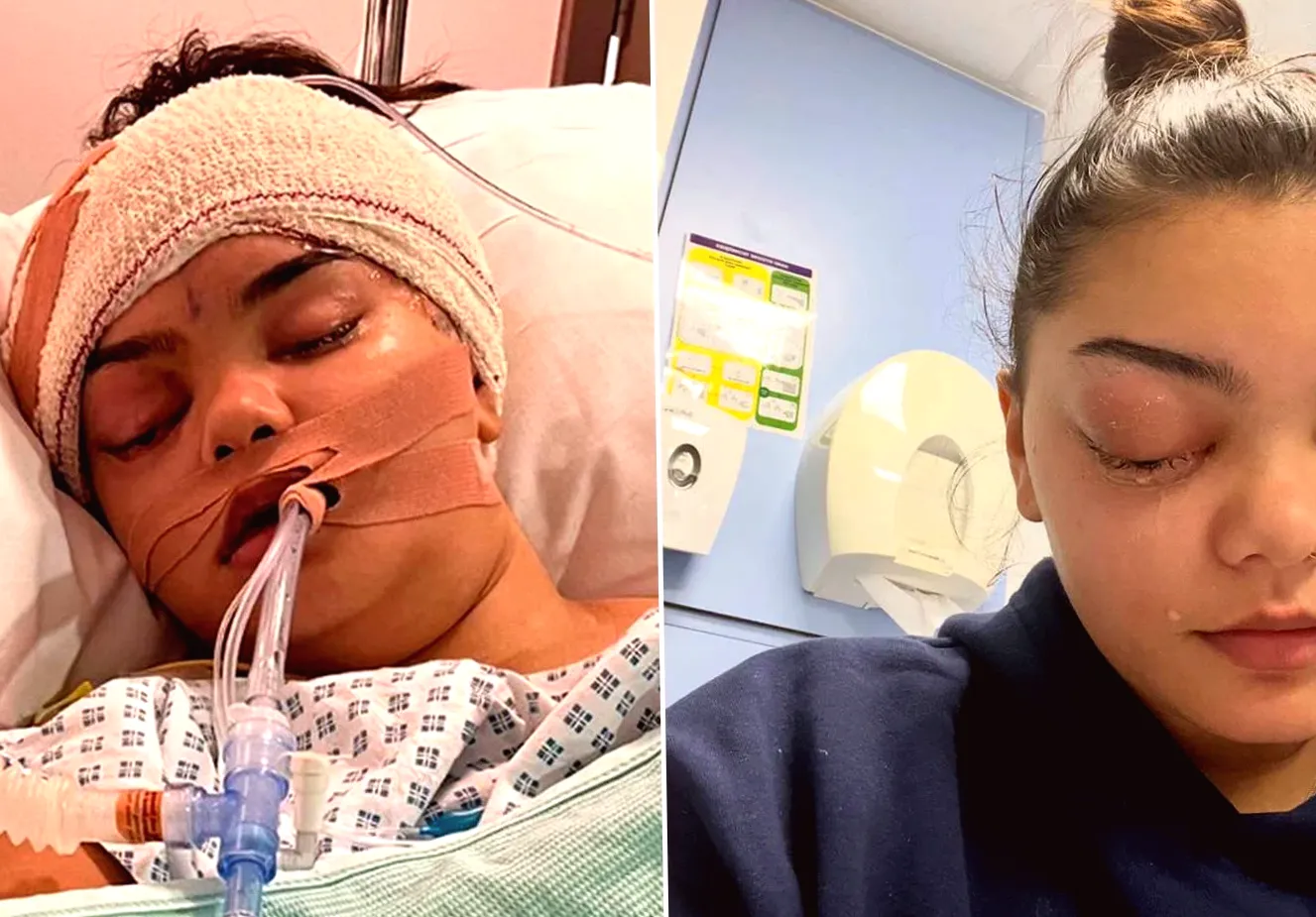 Teen Develops Life-Threatening Infection, Resulting in Eye Popping Out 'Like a Golf Ball' from Sniffles